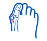 Effective bunion correction